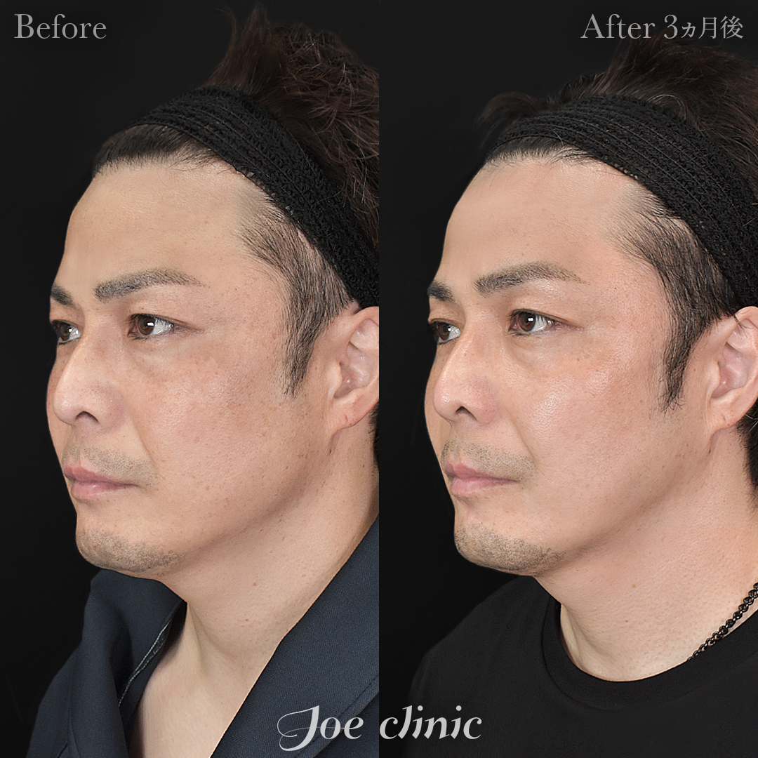 【40代男性】ウルセラリフト(顔全体+顎下)+貴族手術(鼻翼基部プロテーゼ挿入術)|3ヵ月後