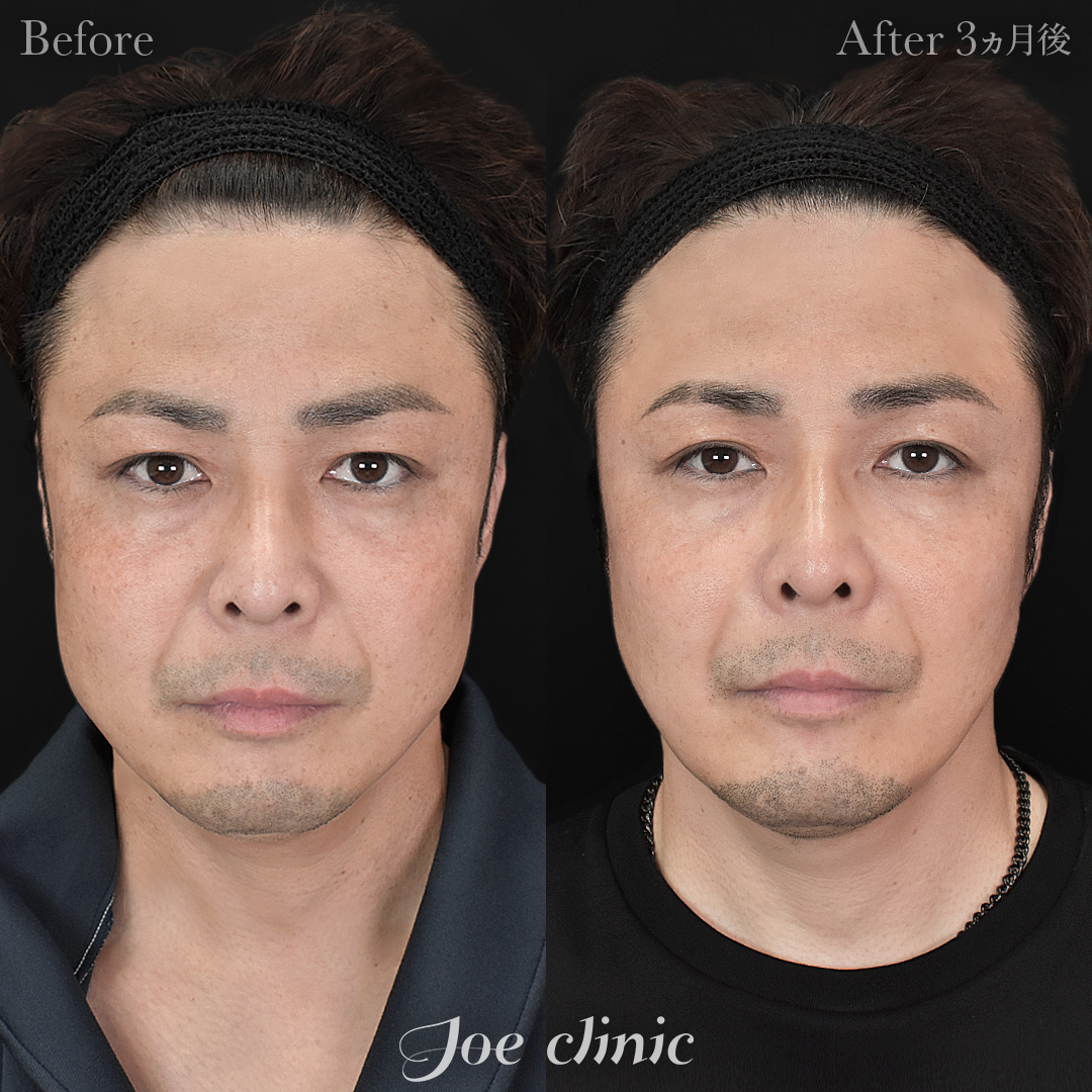 【40代男性】ウルセラリフト(顔全体+顎下)+貴族手術(鼻翼基部プロテーゼ挿入術)|3ヵ月後