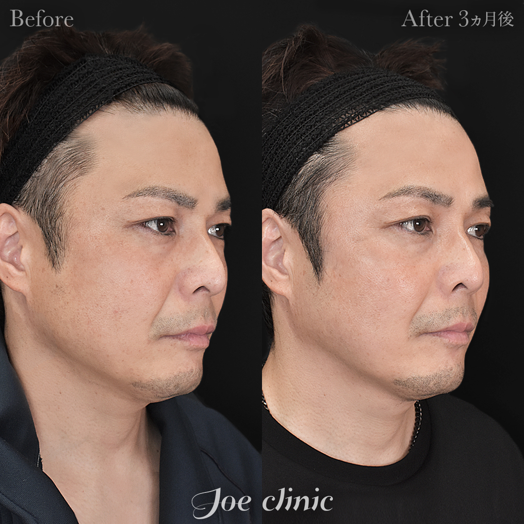 【40代男性】ウルセラリフト(顔全体+顎下)+貴族手術(鼻翼基部プロテーゼ挿入術)|3ヵ月後後