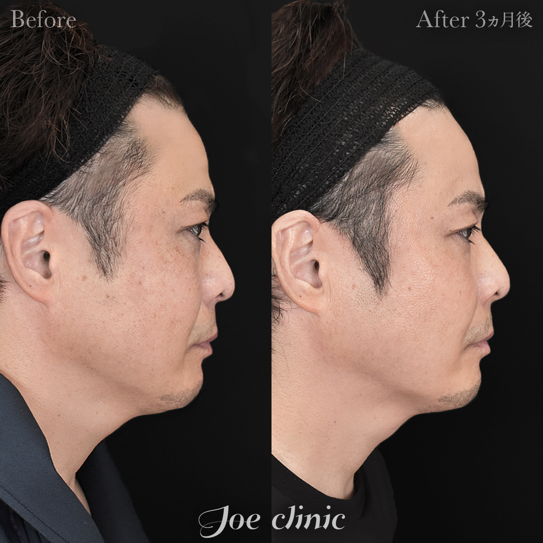 【40代男性】ウルセラリフト(顔全体+顎下)+貴族手術(鼻翼基部プロテーゼ挿入術)|3ヵ月後