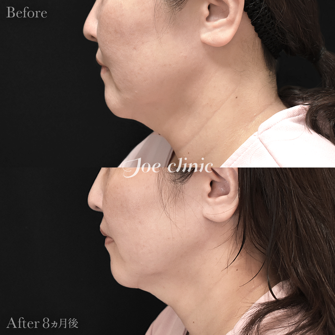 【50代女性】ウルセラリフト(顔全体+顎下)|8ヵ月後