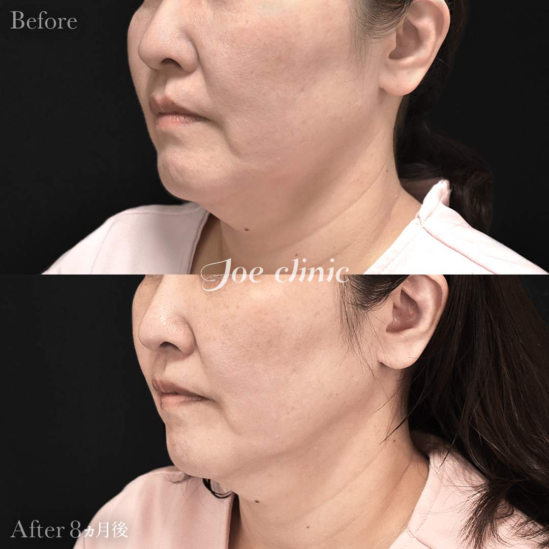【50代女性】ウルセラリフト(顔全体+顎下)|8ヵ月後