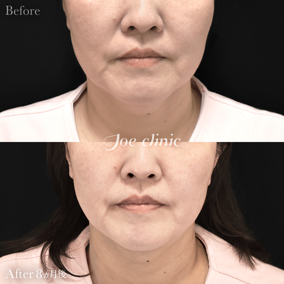 【50代女性】ウルセラリフト(顔全体+顎下)|8ヵ月後
