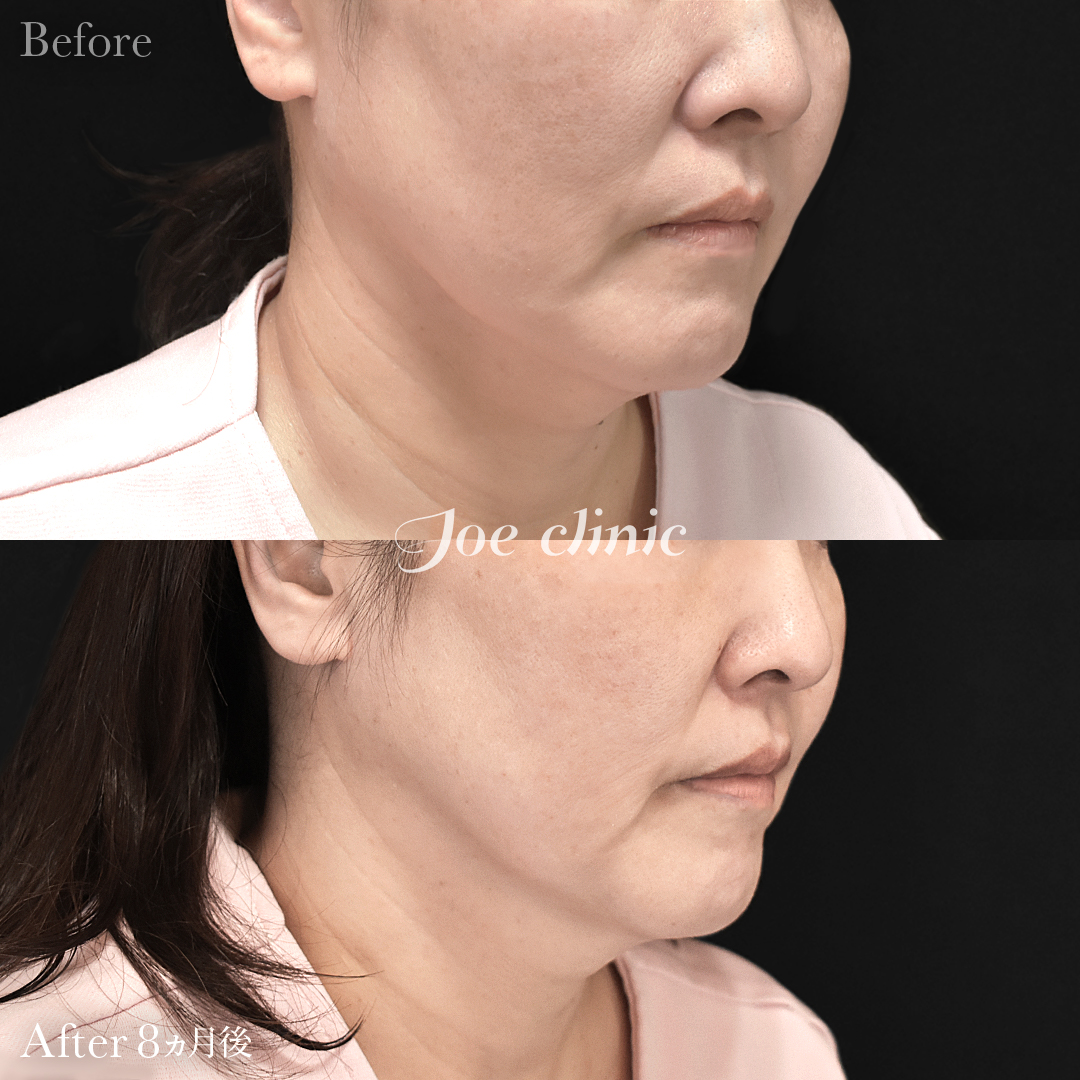 【50代女性】ウルセラリフト（顔全体+顎下）｜8ヵ月後
