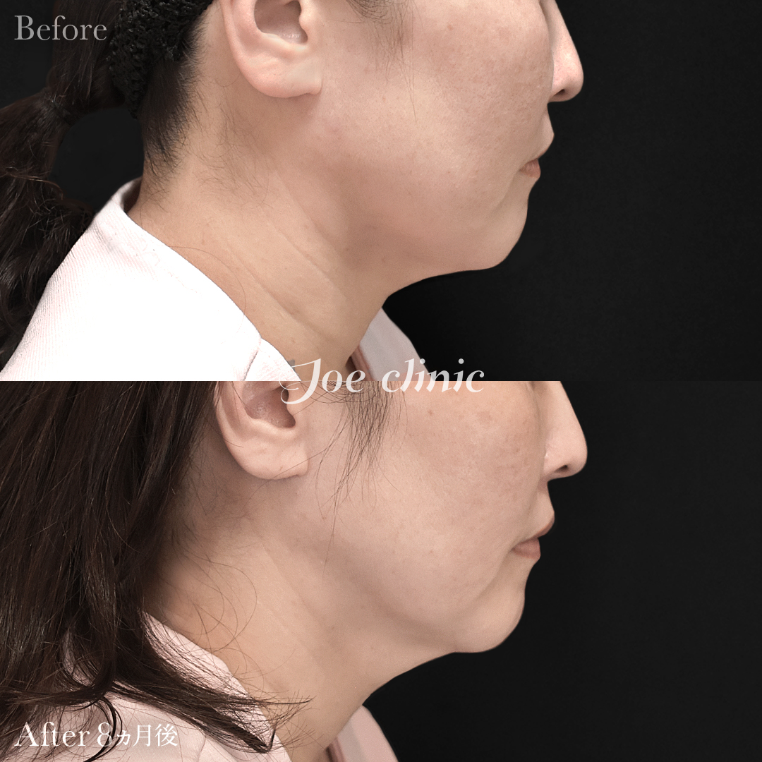 【50代女性】ウルセラリフト(顔全体+顎下)|8ヵ月後