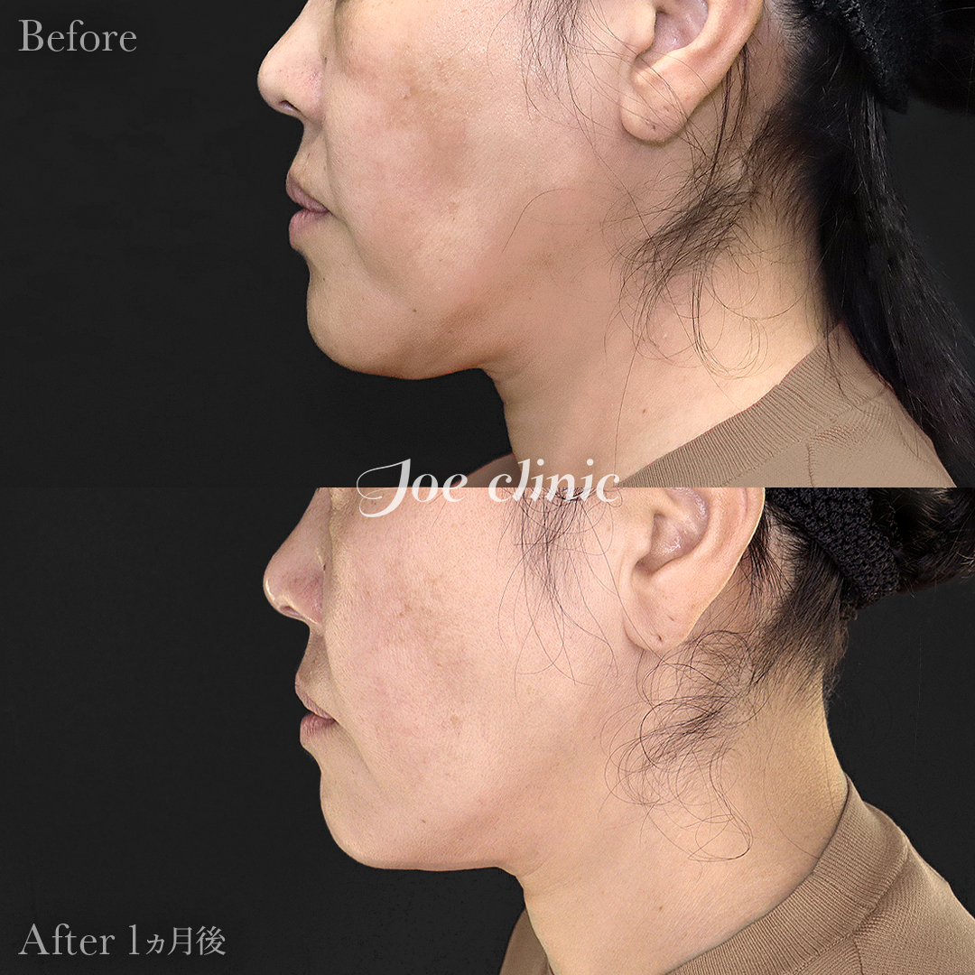 【50代女性】ウルセラリフト(顔全体+顎下)|1ヵ月後