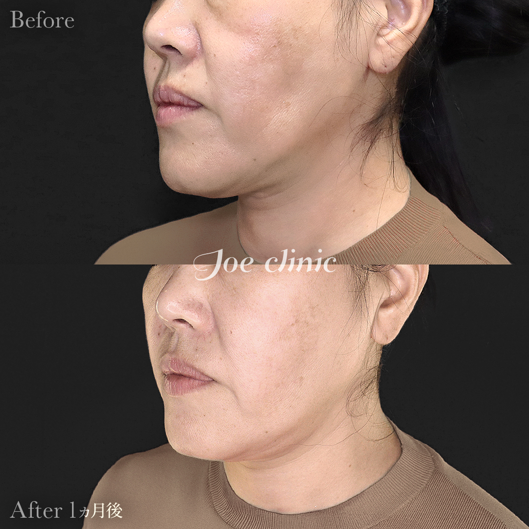 【50代女性】ウルセラリフト（顔全体+顎下）｜1ヵ月後