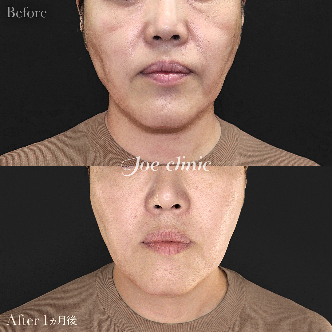 【50代女性】ウルセラリフト(顔全体+顎下)|1ヵ月後