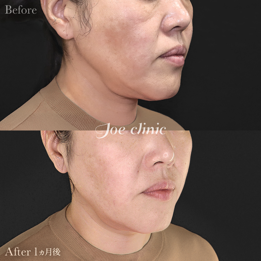 【50代女性】ウルセラリフト(顔全体+顎下)|1ヵ月後