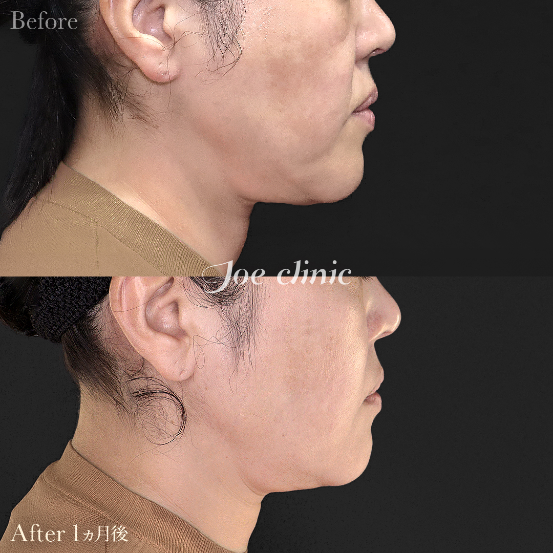 【50代女性】ウルセラリフト(顔全体+顎下)|1ヵ月後