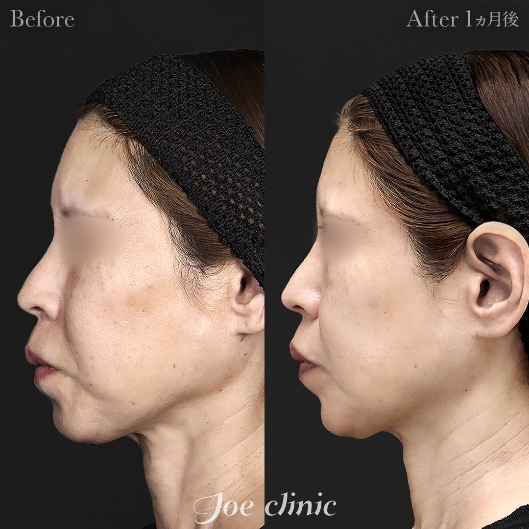 【50代女性】ウルセラリフト(顔全体+顎下)|1ヵ月後