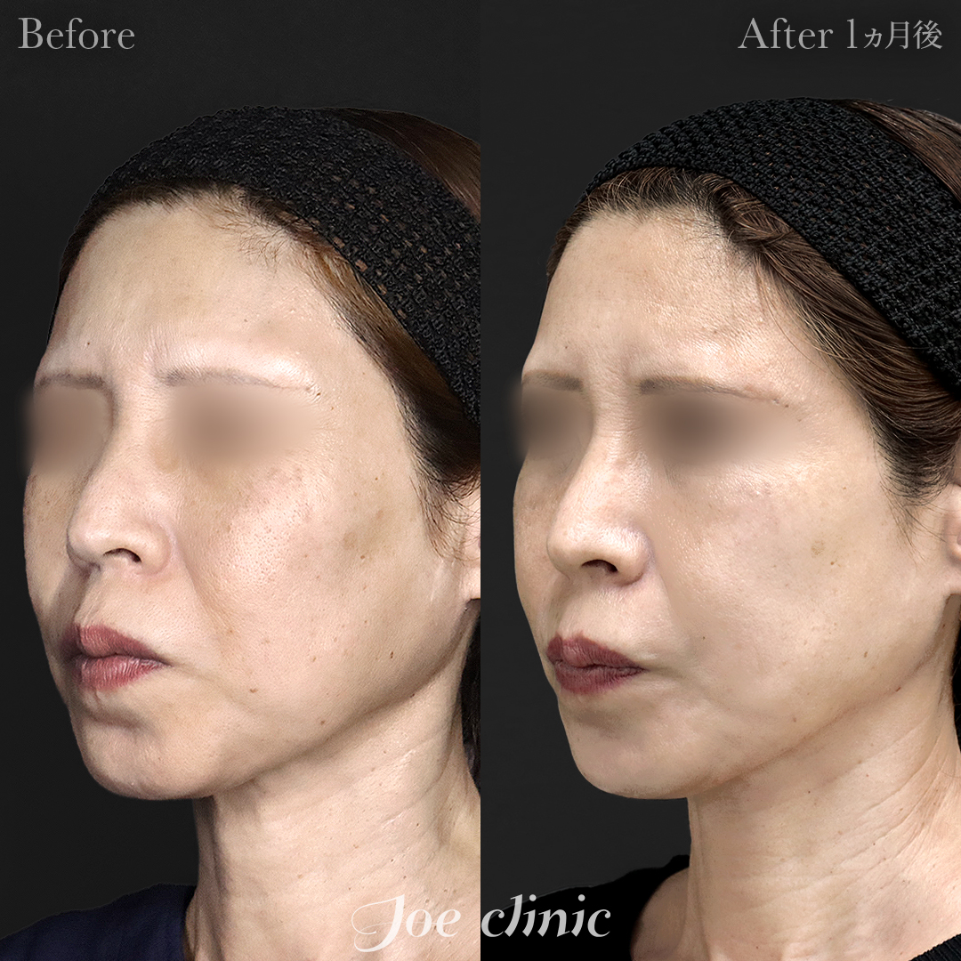 【50代女性】ウルセラリフト(顔全体+顎下)|1ヵ月後