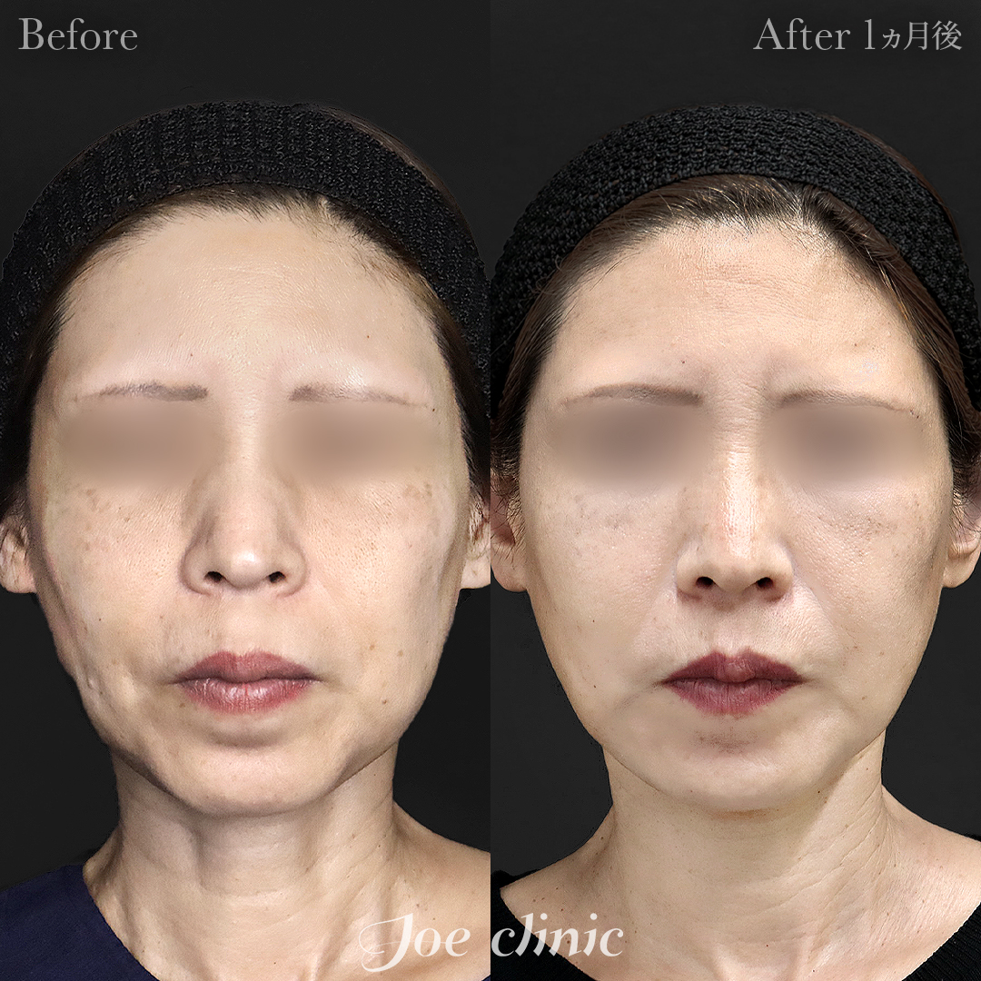 【50代女性】ウルセラリフト（顔全体+顎下）｜1ヵ月後