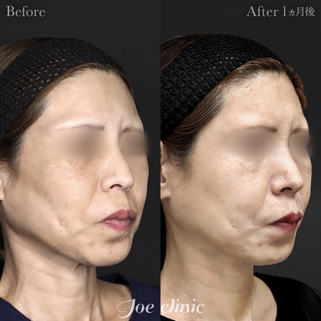 【50代女性】ウルセラリフト(顔全体+顎下)|1ヵ月後