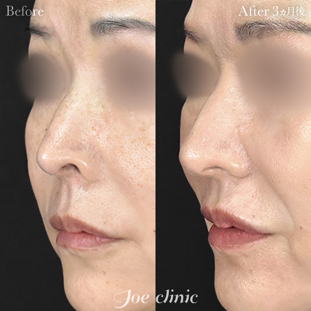 【60代女性】鼻孔縁下降術（コンポジットグラフト）｜3ヵ月後