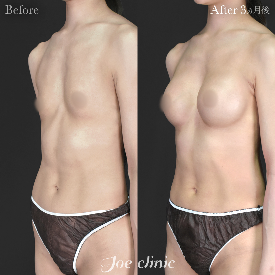 【20代女性】シリコンバッグ豊胸モティバ2（290cc×左右）｜3ヵ月後