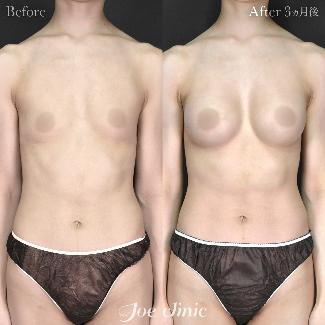 【20代女性】シリコンバッグ豊胸モティバ2（290cc×左右）｜3ヵ月後