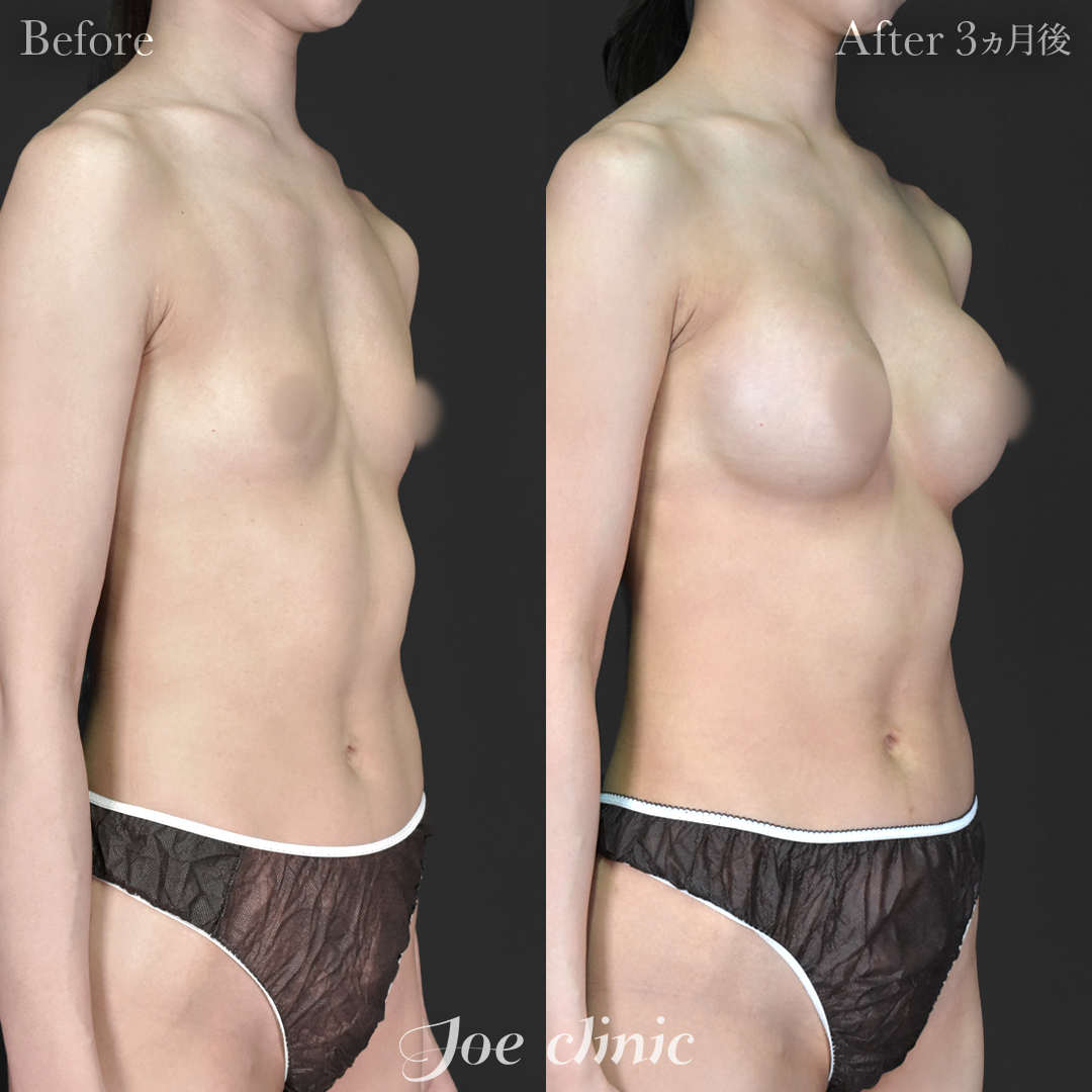 【20代女性】シリコンバッグ豊胸モティバ2（290cc×左右）｜3ヵ月後