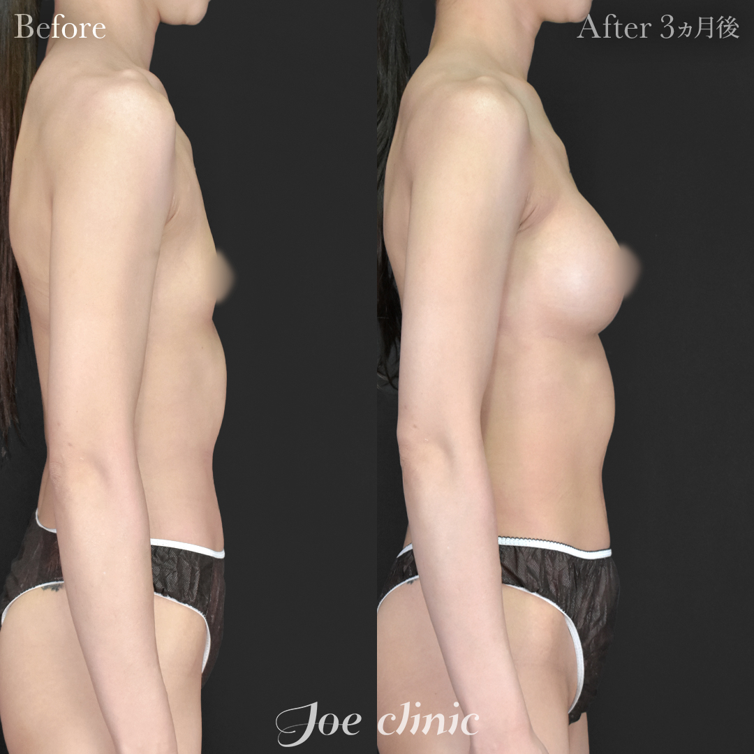 【20代女性】シリコンバッグ豊胸モティバ2（290cc×左右）｜3ヵ月後