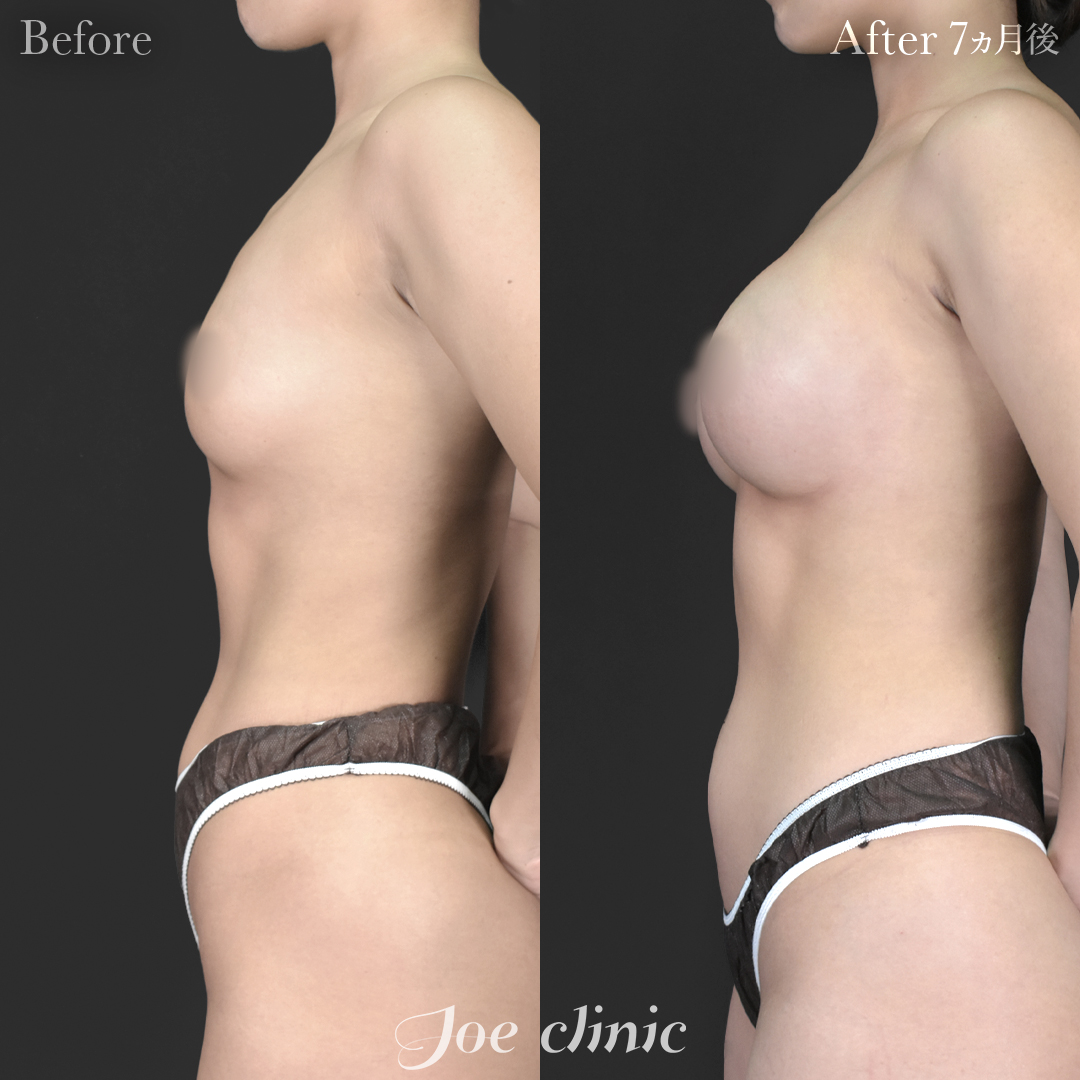 【30代女性】シリコンバッグ豊胸モティバ2（330cc×左右）｜7ヵ月後