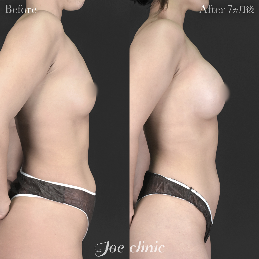 【30代女性】シリコンバッグ豊胸モティバ2（330cc×左右）｜7ヵ月後