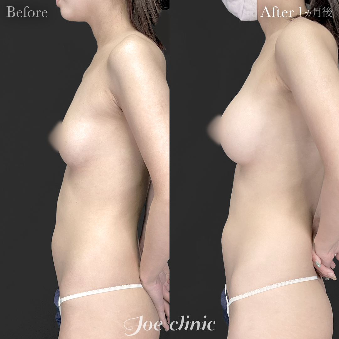 【20代女性】ハイブリッド豊胸(シリコンバッグ豊胸+脂肪幹細胞注入豊胸)|1ヵ月後