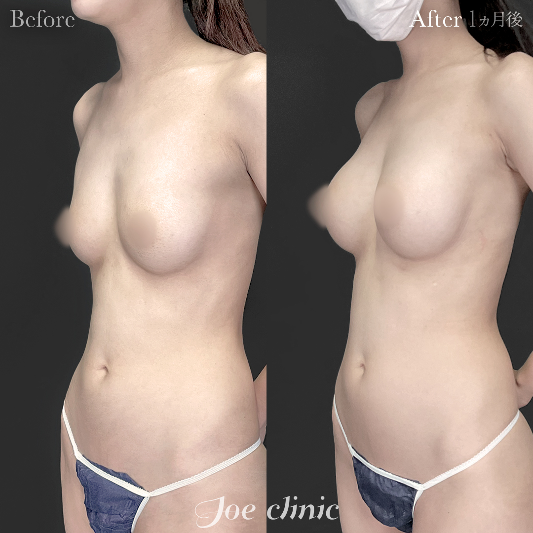 【20代女性】ハイブリッド豊胸(シリコンバッグ豊胸+脂肪幹細胞注入豊胸)|1ヵ月後