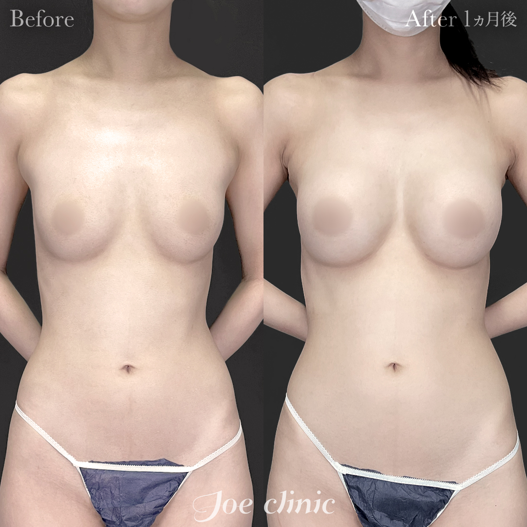 【20代女性】ハイブリッド豊胸(シリコンバッグ豊胸+脂肪幹細胞注入豊胸)|1ヵ月後
