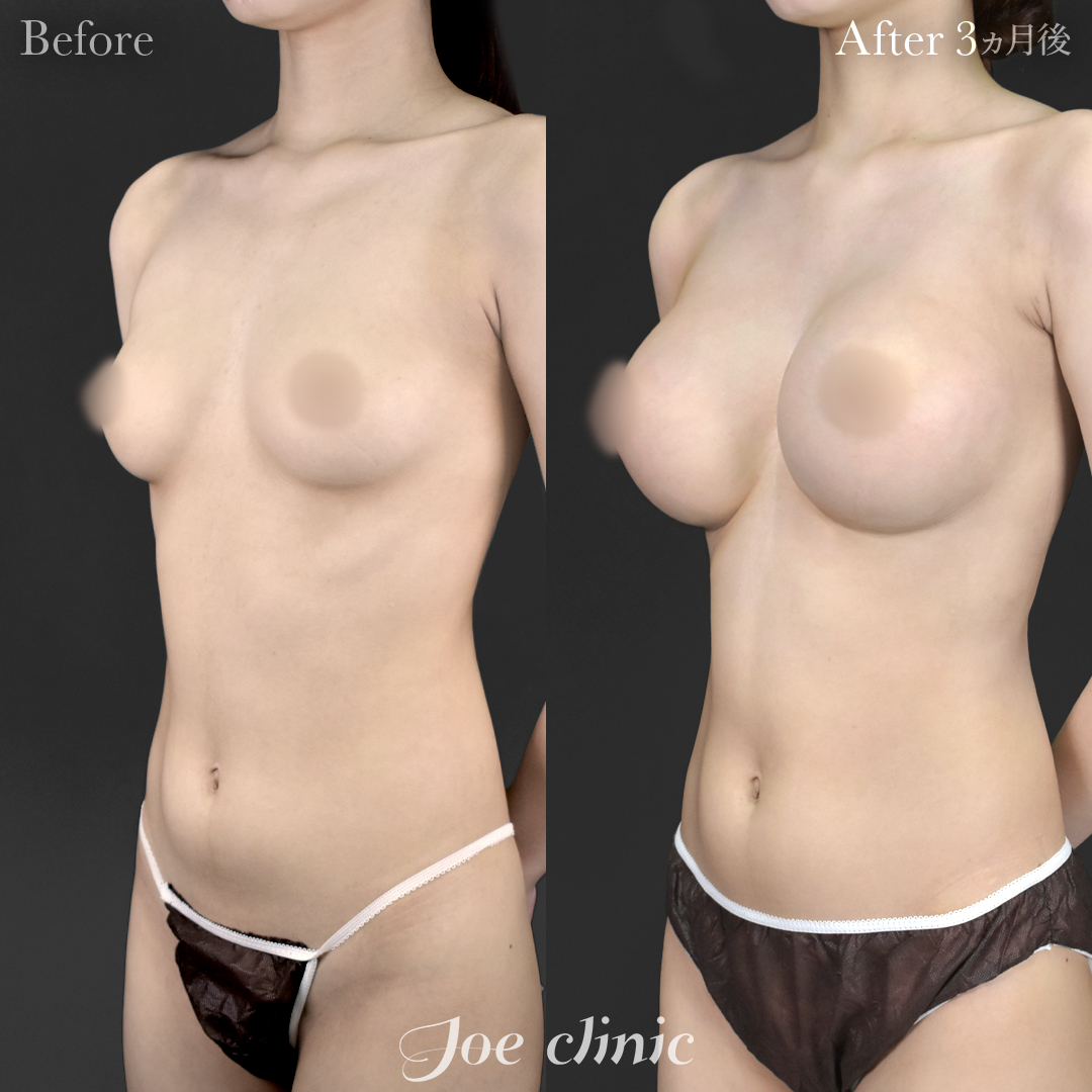 【20代女性】ハイブリッド豊胸(シリコンバッグ豊胸+脂肪幹細胞注入豊胸)|3ヵ月後