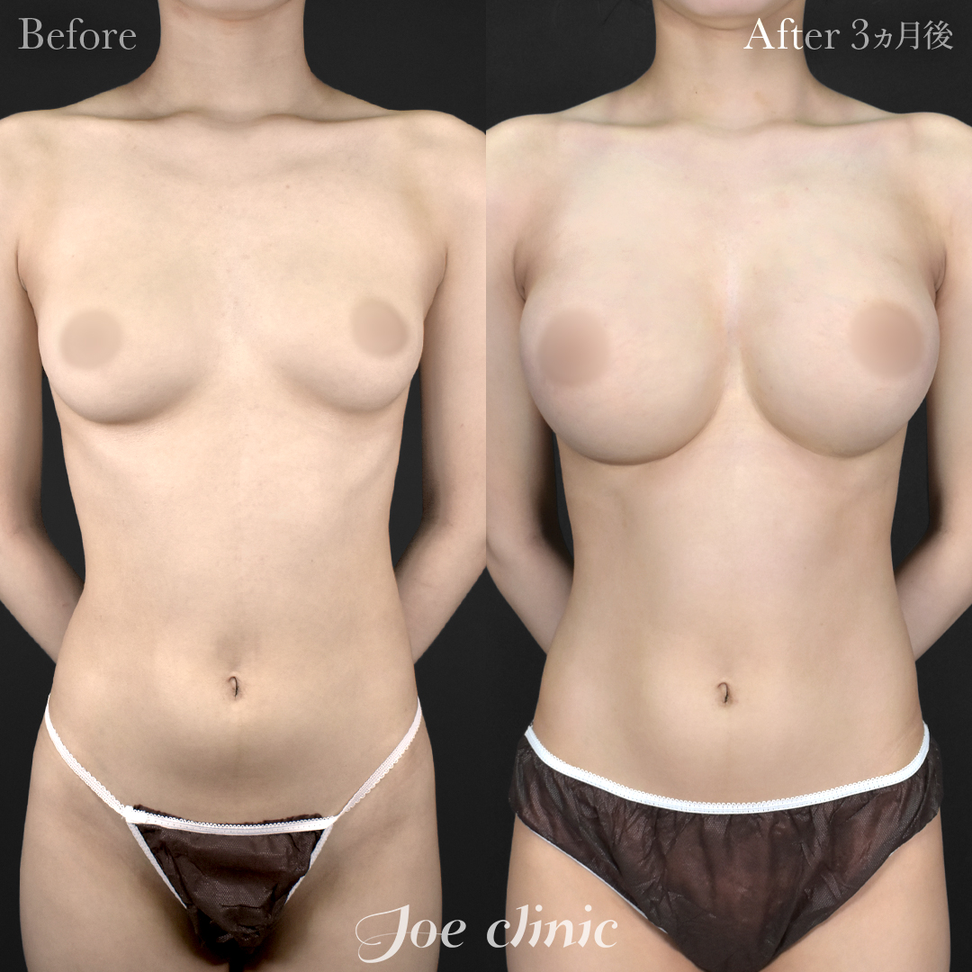 【20代女性】ハイブリッド豊胸(シリコンバッグ豊胸+脂肪幹細胞注入豊胸)|3ヵ月後