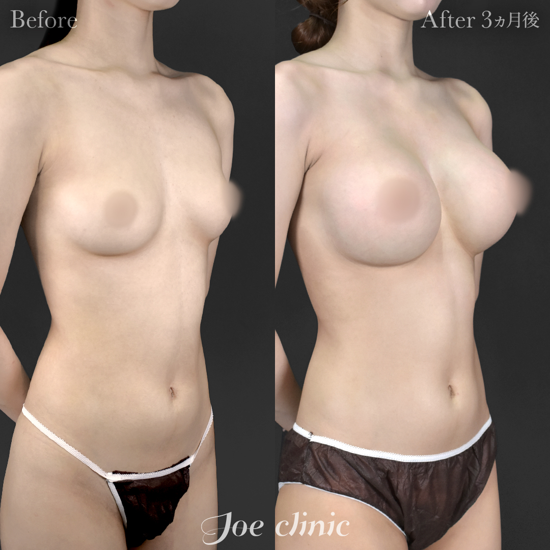 【20代女性】ハイブリッド豊胸(シリコンバッグ豊胸+脂肪幹細胞注入豊胸)|3ヵ月後