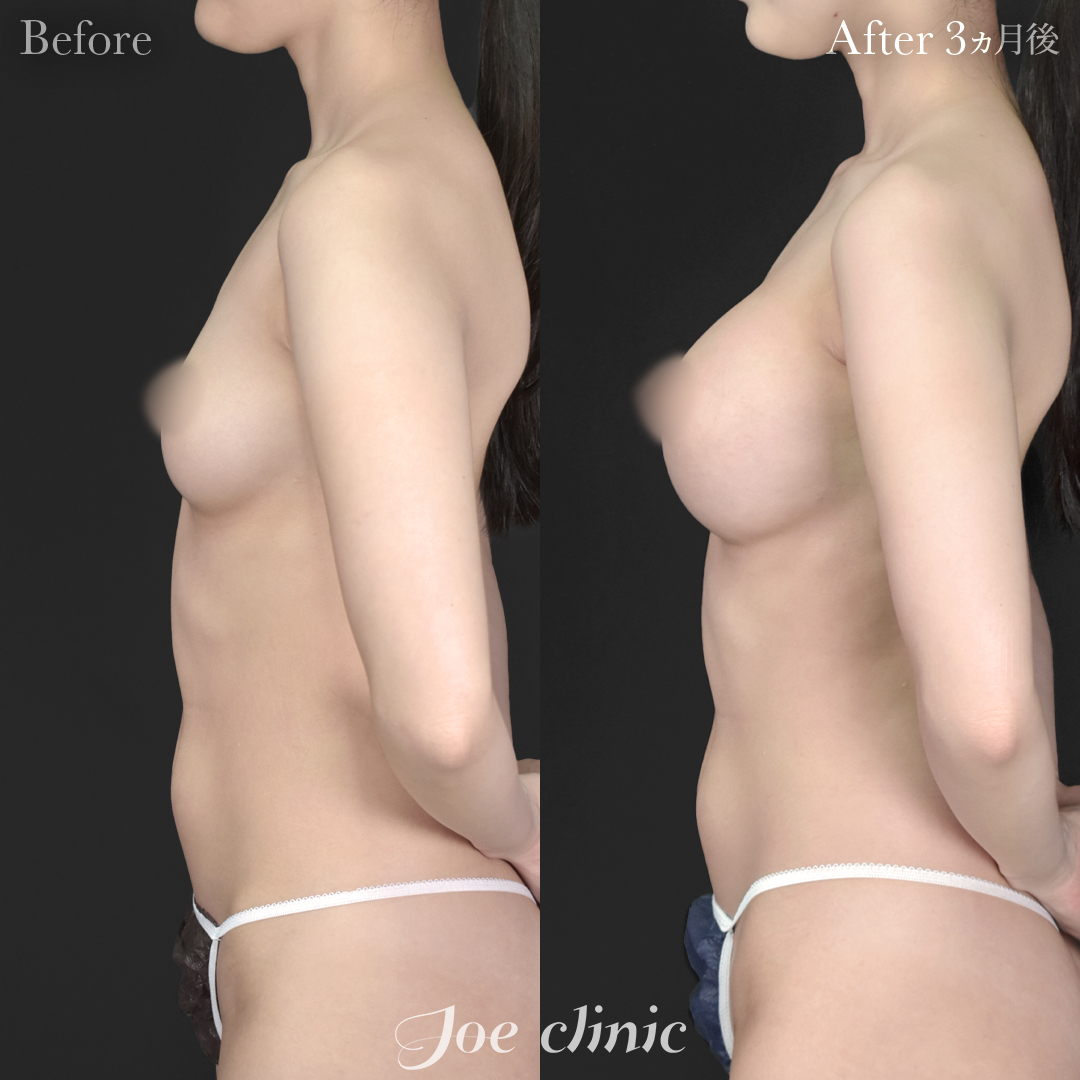 【20代女性】ハイブリッド豊胸(シリコンバッグ豊胸+脂肪幹細胞注入豊胸)|3ヵ月後