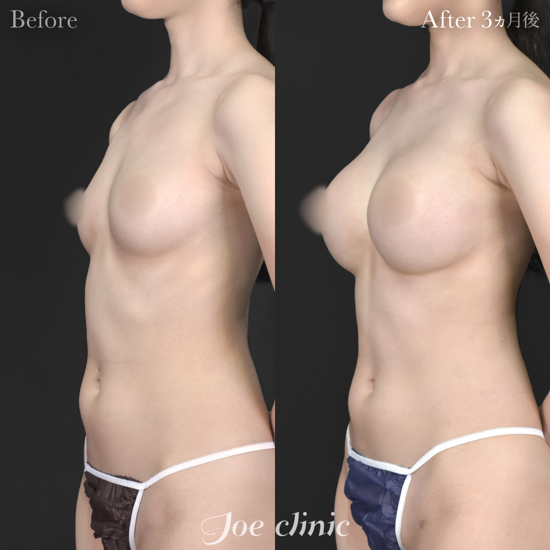 【20代女性】ハイブリッド豊胸(シリコンバッグ豊胸+脂肪幹細胞注入豊胸)|3ヵ月後