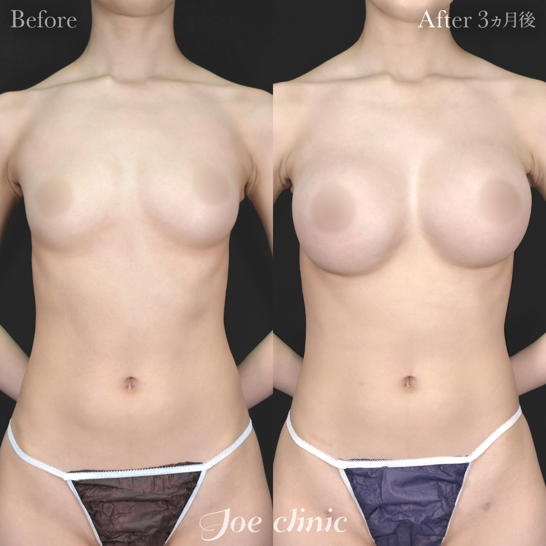 【20代女性】ハイブリッド豊胸(シリコンバッグ豊胸+脂肪幹細胞注入豊胸)|3ヵ月後