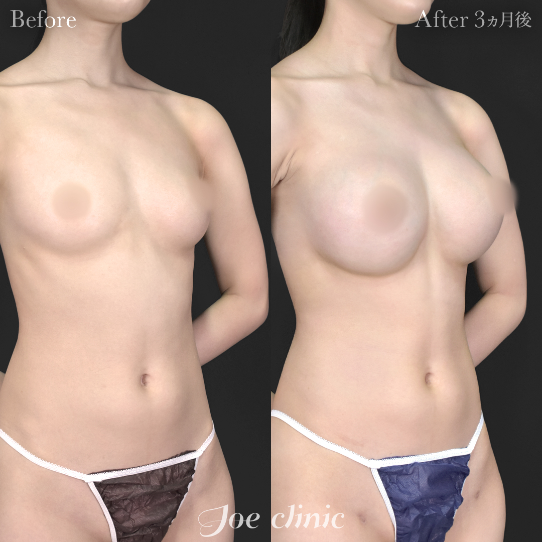 【20代女性】ハイブリッド豊胸(シリコンバッグ豊胸+脂肪幹細胞注入豊胸)|3ヵ月後