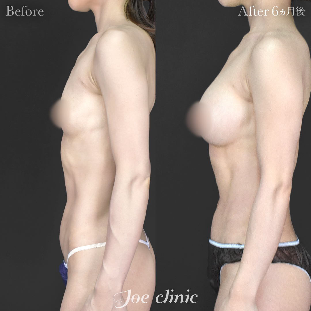 【30代女性】ハイブリッド豊胸（シリコンバッグ豊胸＋脂肪幹細胞注入豊胸）｜6ヵ月後