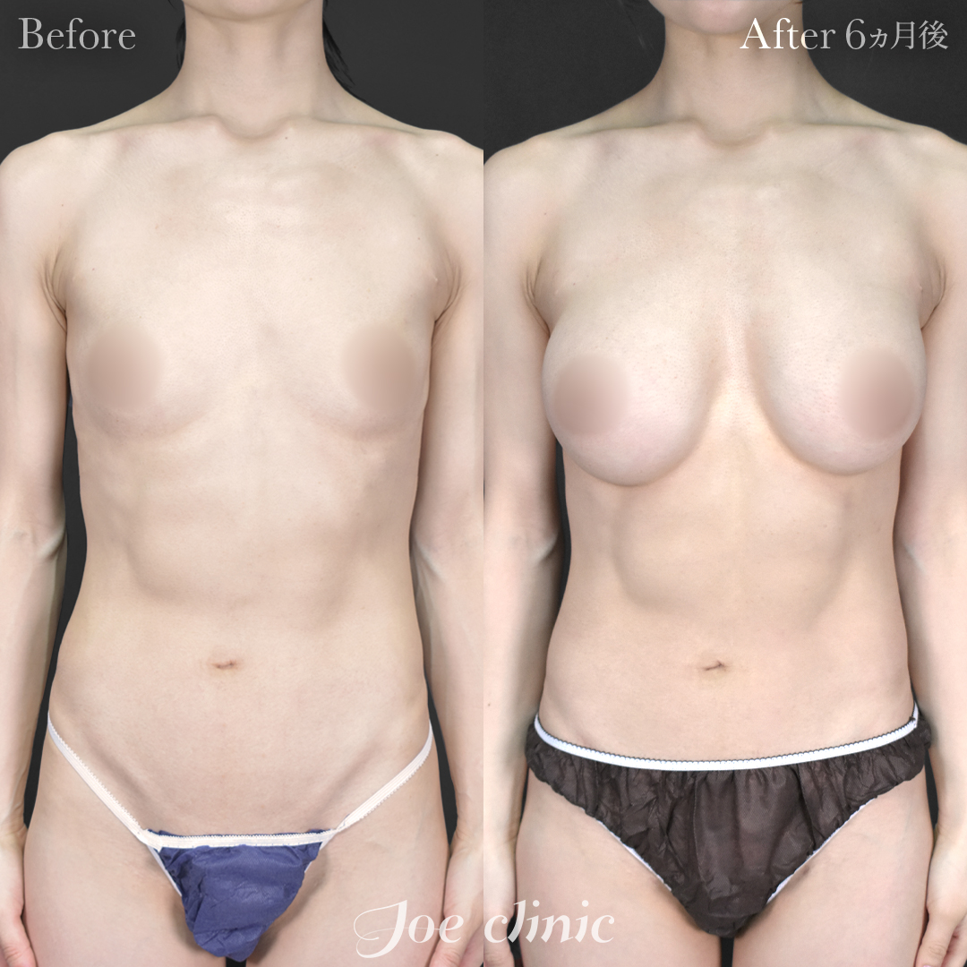 【30代女性】ハイブリッド豊胸（シリコンバッグ豊胸＋脂肪幹細胞注入豊胸）｜6ヵ月後