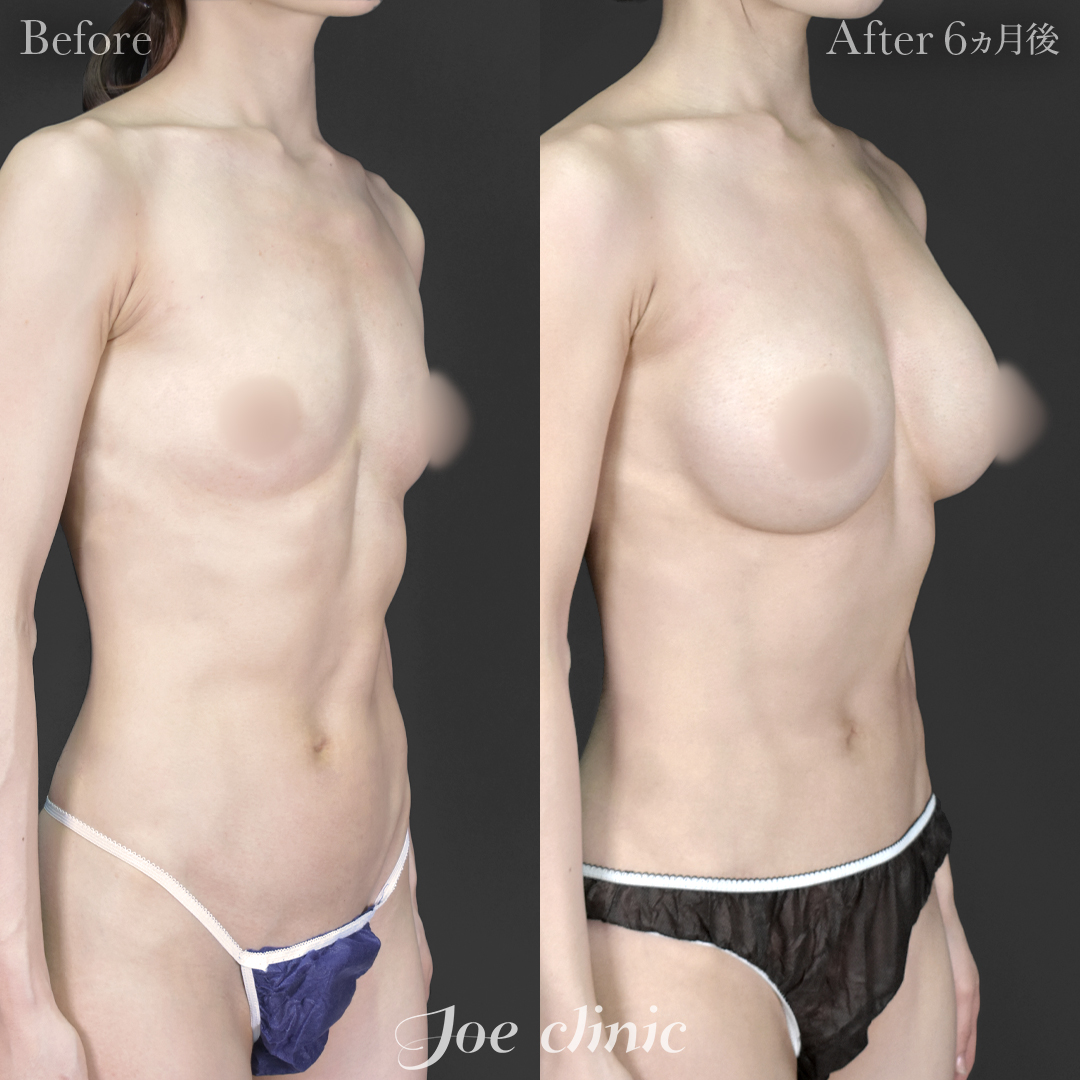 【30代女性】ハイブリッド豊胸(シリコンバッグ豊胸+脂肪幹細胞注入豊胸)|6ヵ月後