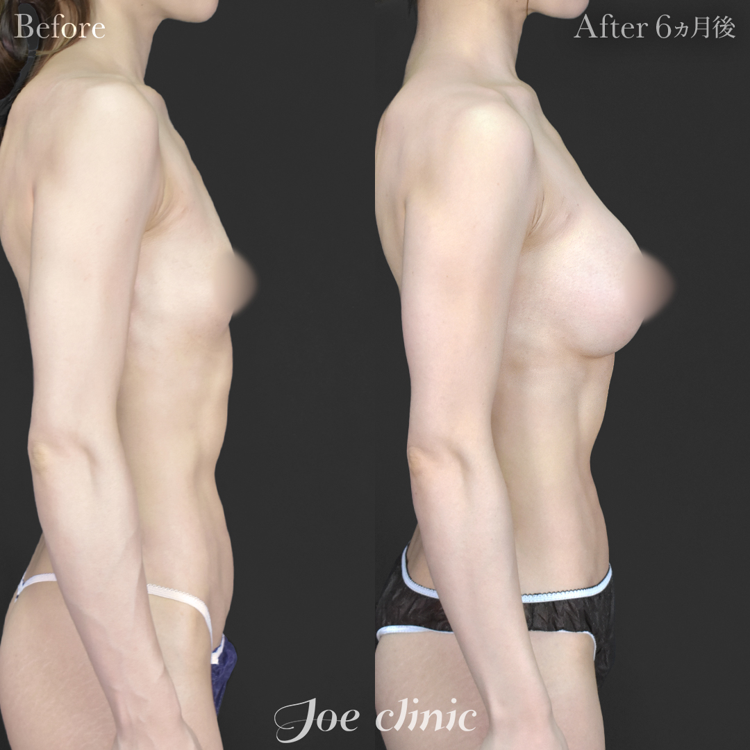 【30代女性】ハイブリッド豊胸（シリコンバッグ豊胸＋脂肪幹細胞注入豊胸）｜6ヵ月後