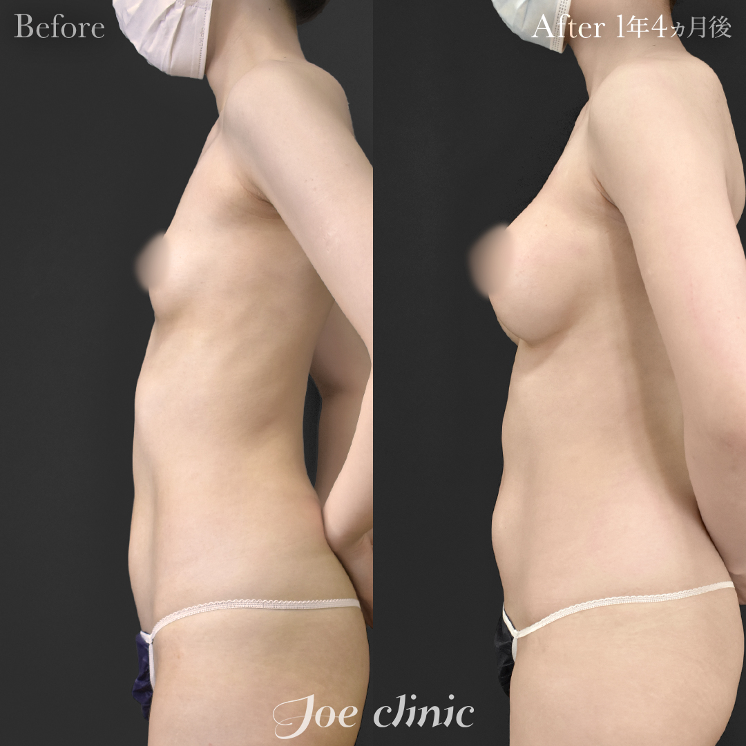 【20代女性】ハイブリッド豊胸(シリコンバッグ豊胸+脂肪幹細胞注入豊胸)|1年4ヵ月後