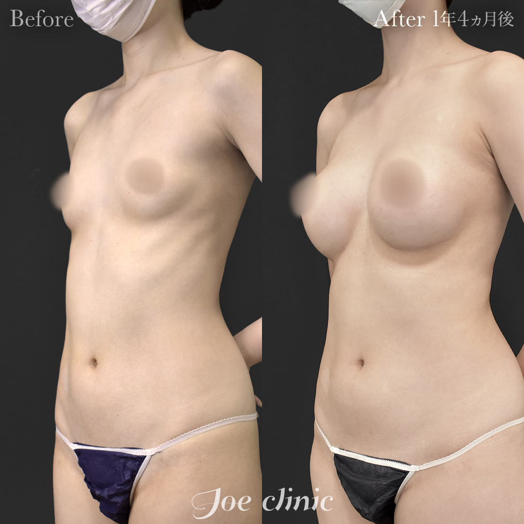 【20代女性】ハイブリッド豊胸(シリコンバッグ豊胸+脂肪幹細胞注入豊胸)|1年4ヵ月後