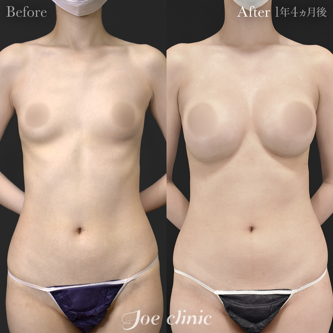 【20代女性】ハイブリッド豊胸(シリコンバッグ豊胸+脂肪幹細胞注入豊胸)|1年4ヵ月後