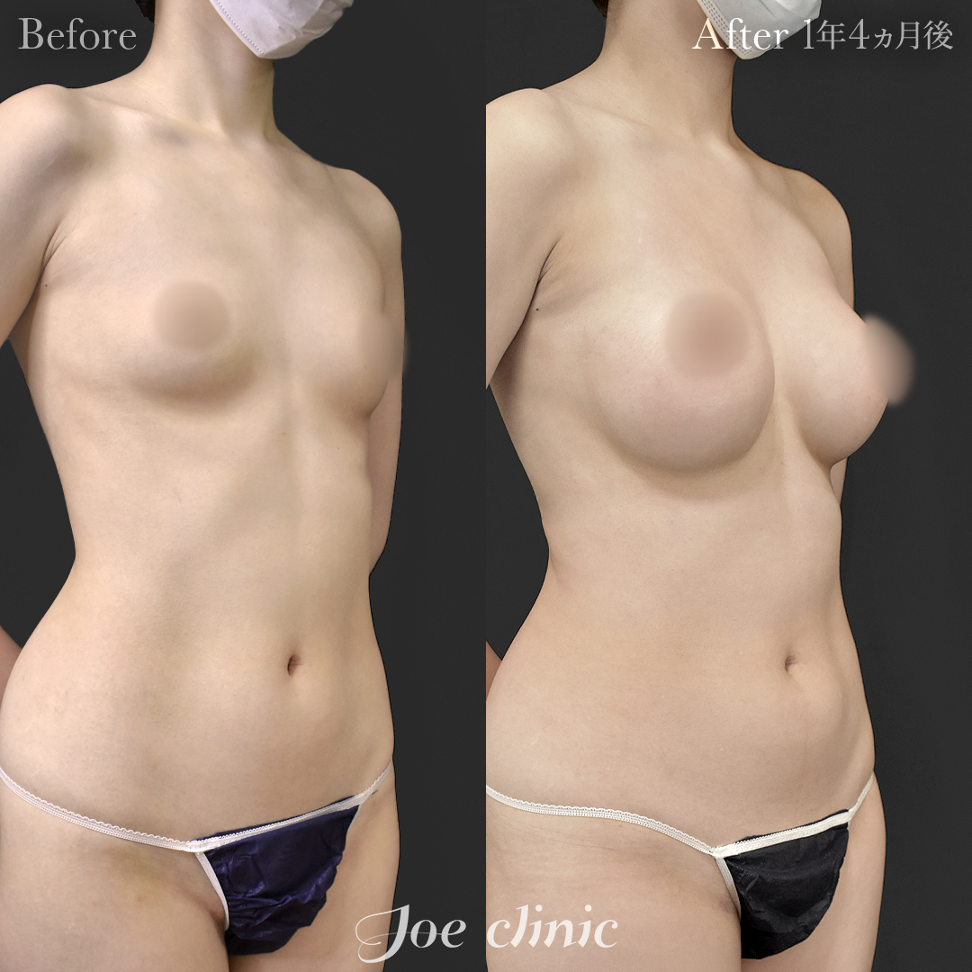 【20代女性】ハイブリッド豊胸(シリコンバッグ豊胸+脂肪幹細胞注入豊胸)|1年4ヵ月後