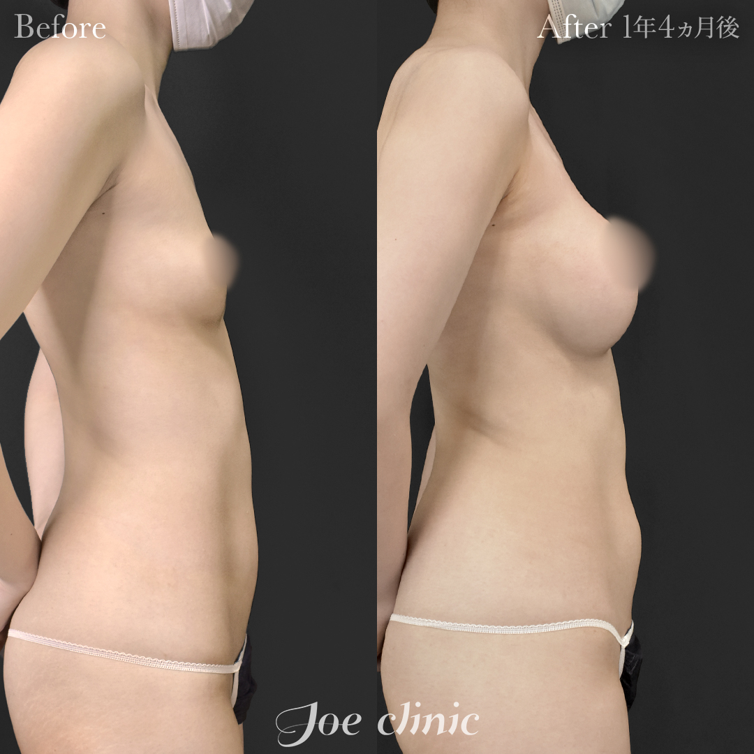 【20代女性】ハイブリッド豊胸(シリコンバッグ豊胸+脂肪幹細胞注入豊胸)|1年4ヵ月後