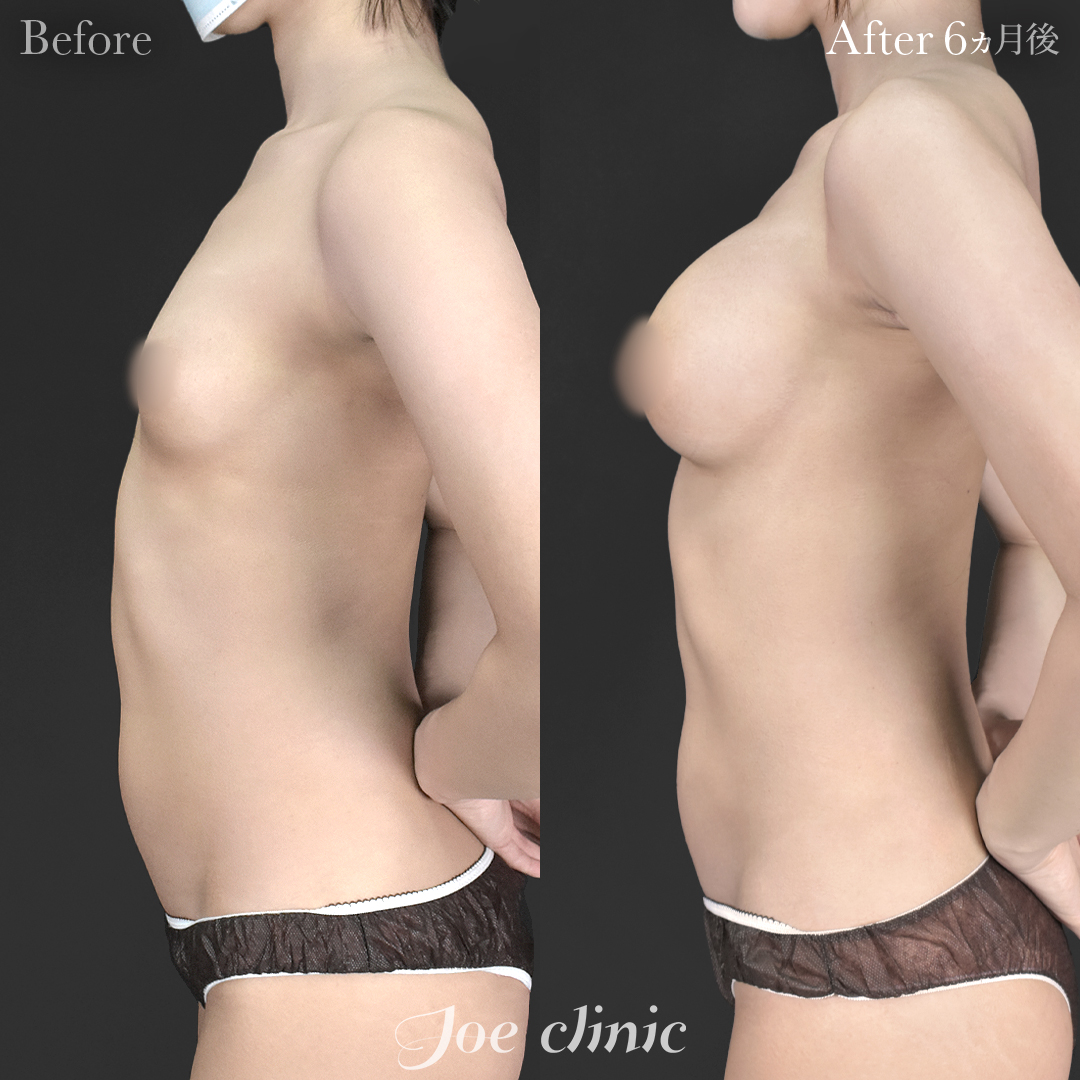 【20代女性】シリコンバッグ豊胸モティバ2(右360cc・左380cc)|6ヵ月後