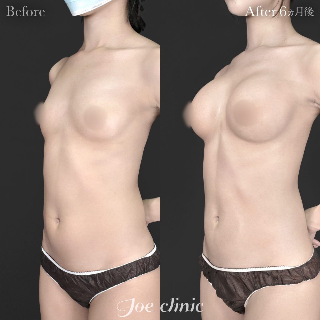 【20代女性】シリコンバッグ豊胸モティバ2(右360cc・左380cc)|6ヵ月後