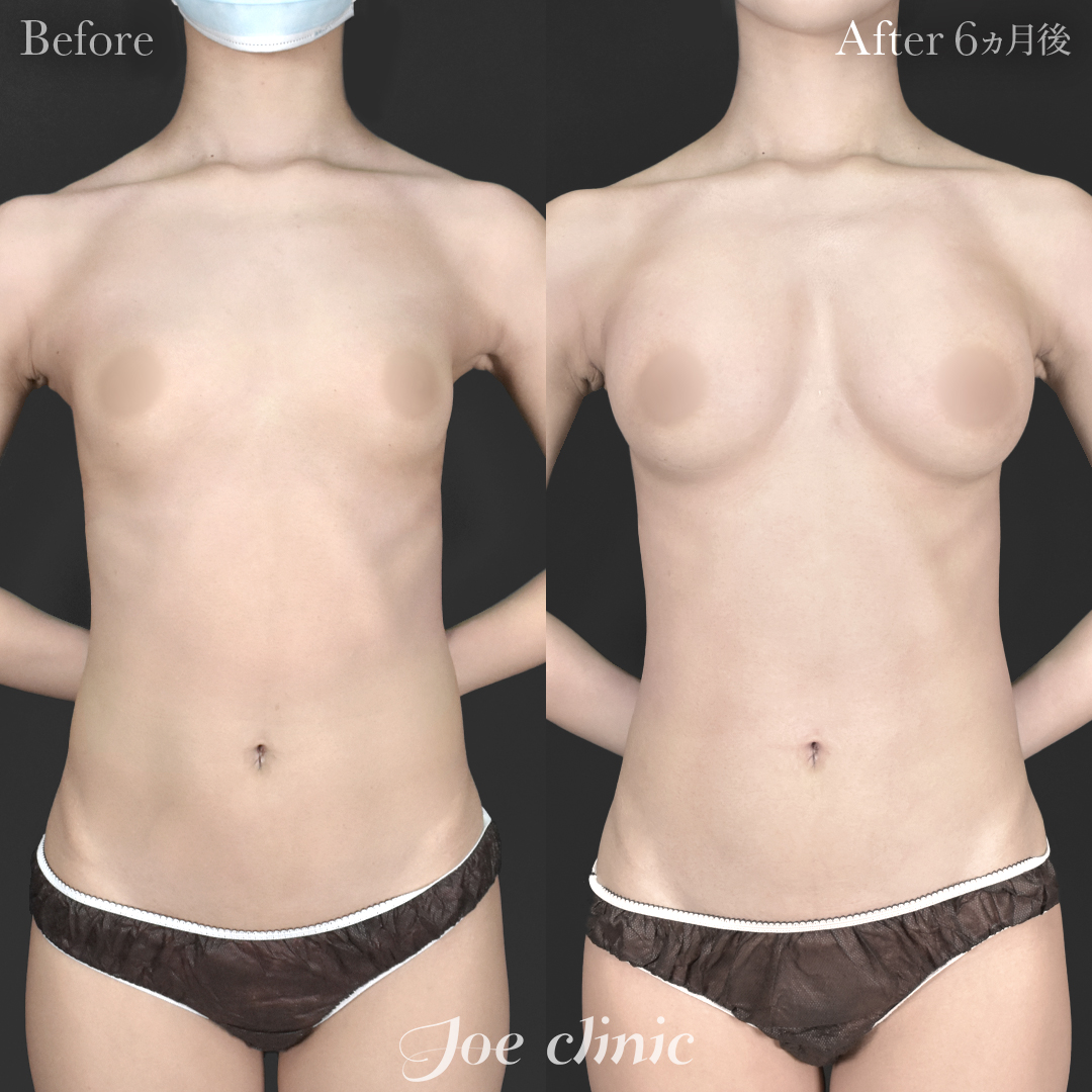 【20代女性】シリコンバッグ豊胸モティバ2(右360cc・左380cc)|6ヵ月後