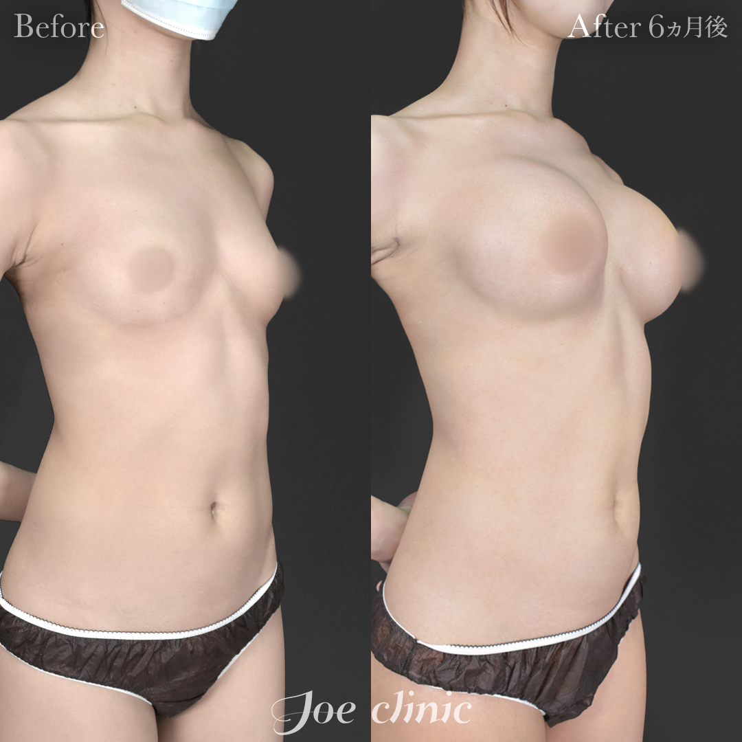 【20代女性】シリコンバッグ豊胸モティバ2(右360cc・左380cc)|6ヵ月後