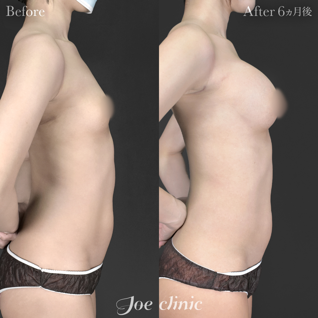 【20代女性】シリコンバッグ豊胸モティバ2(右360cc・左380cc)|6ヵ月後