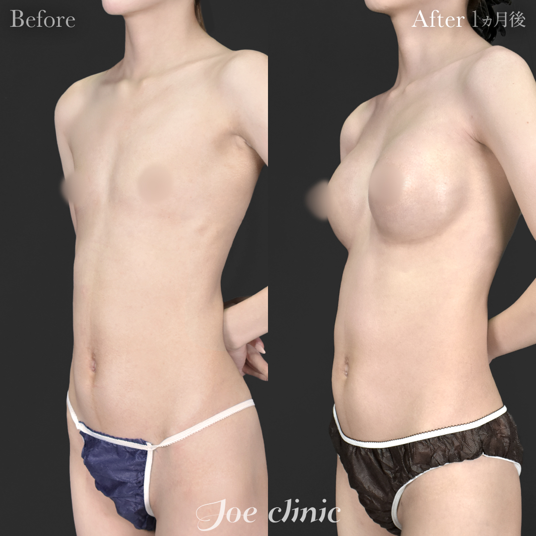 【20代女性】ハイブリッド豊胸(シリコンバッグ豊胸+脂肪幹細胞注入豊胸)|1ヵ月後